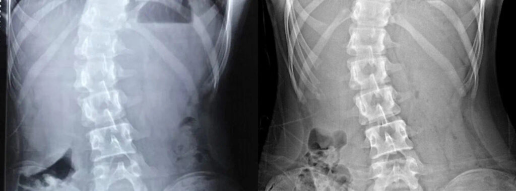 Xray Frontal View Before and After UP Clinic Shanghai China